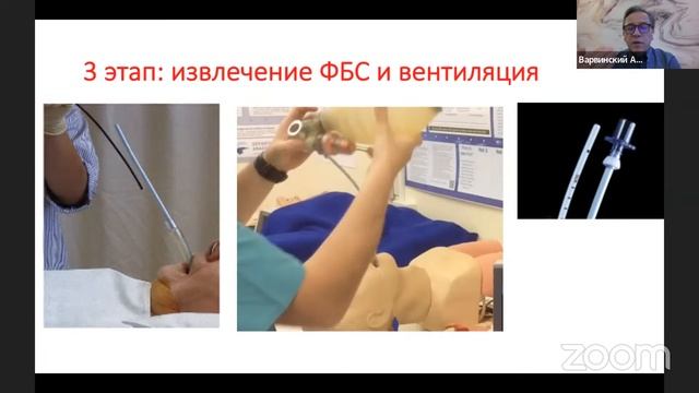 Интубация трахеи через надгортанные воздуховоды с помощью фибробронхоскопа и катетера Aintree смотреть онлайн