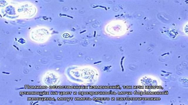 Мутная моча у беременных смотреть онлайн