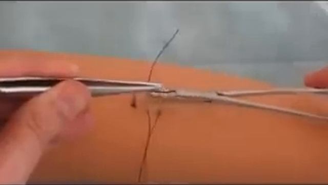 Техника наложения п образного шва смотреть онлайн