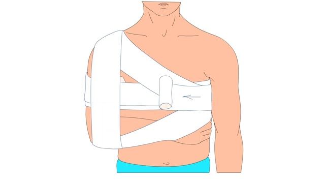 Наложение повязки при переломе ключицы смотреть онлайн