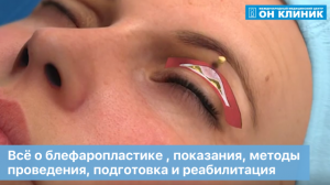 Всё о блефаропластике , показания, методы проведения, подготовка и реабилитация