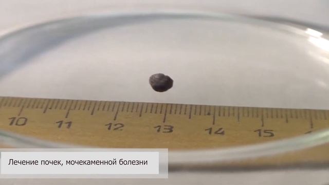 Камни в почках Лечение Ундоры смотреть онлайн