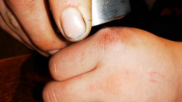 Достаём металлический осколок из под кожи при помощи поискового магнита. смотреть онлайн