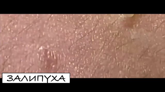 ПРЫЩИ ВЫДАВЛИВАНИЕ. ВЫДАВЛИВАНИЕ ПРЫЩЕЙ. ВЫДАВЛИВАНИЕ ЧЕРНЫХ ТОЧЕК НА ЛИЦЕ. ПРЫЩИ ВЫДАВЛИВАНИЕ НОВО