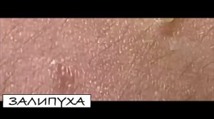 ПРЫЩИ ВЫДАВЛИВАНИЕ. ВЫДАВЛИВАНИЕ ПРЫЩЕЙ. ВЫДАВЛИВАНИЕ ЧЕРНЫХ ТОЧЕК НА ЛИЦЕ. ПРЫЩИ ВЫДАВЛИВАНИЕ НОВО