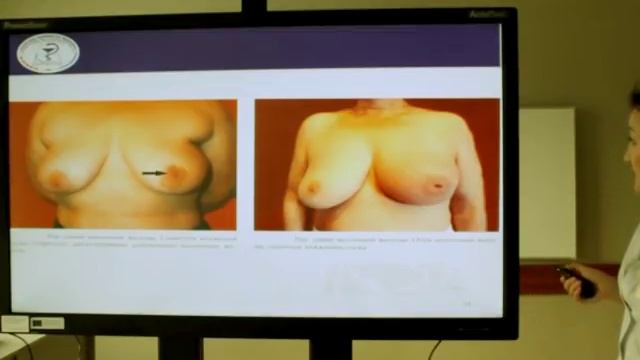 «Сүт безі обыры»