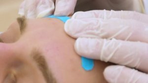 Неврит лицевого нерва (Паралич Белла). Массаж. Кинезиотерапия.