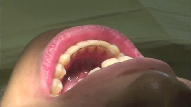 Fixed Retainer Delivery With Hildebrand Orthodontics смотреть онлайн