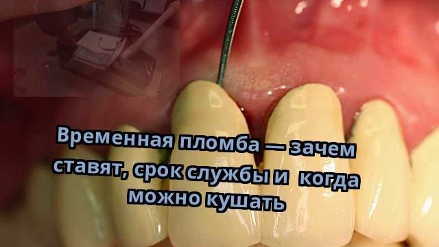 Временная пломба — зачем ставят, срок службы и когда можно кушать смотреть онлайн