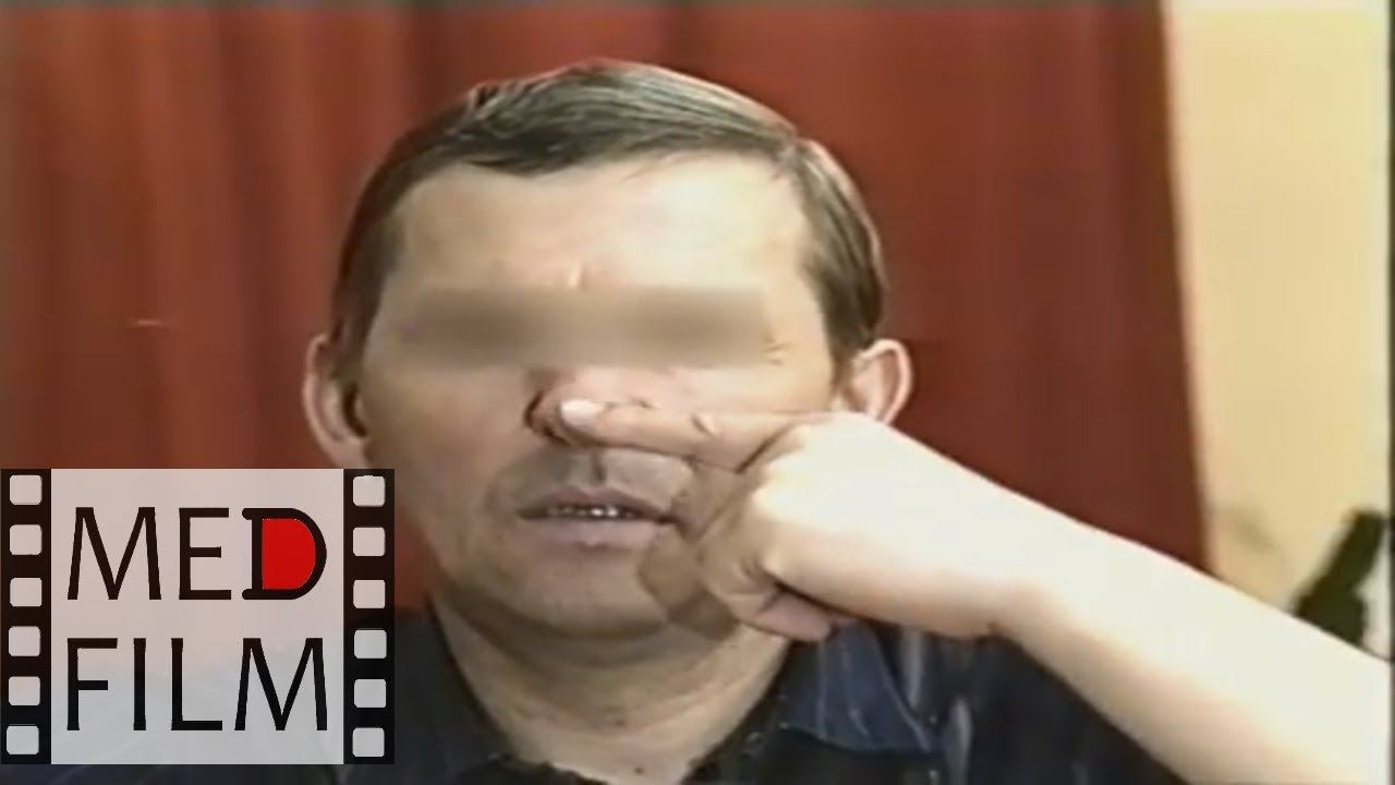 Сенситивная атаксия © Sensitive Ataxia