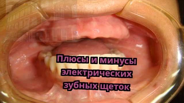 Плюсы и минусы электрических зубных щеток смотреть онлайн