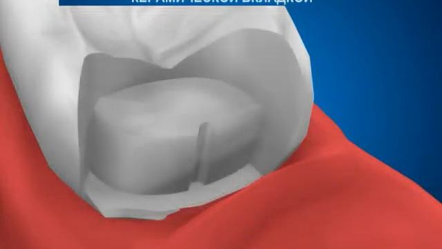 Ортопедическая стоматология в Краснодаре-Восстановление коронковой части зуба керамической вкладкой смотреть онлайн