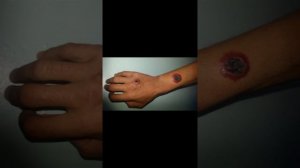 сибирская язва