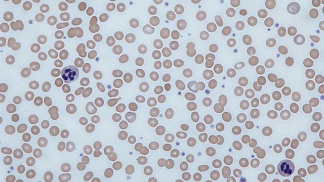 Anemia | Wikipedia audio article смотреть онлайн