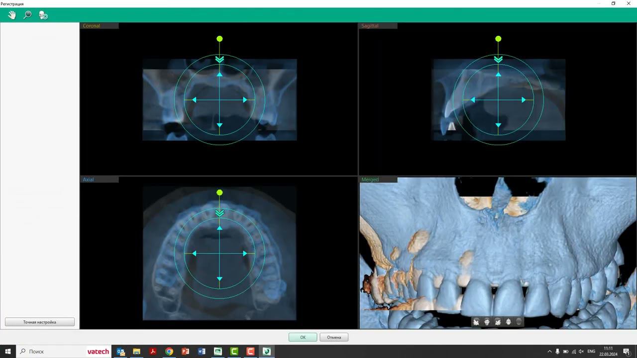 Функция наложения 2х КТ в программе Ez3D i смотреть онлайн