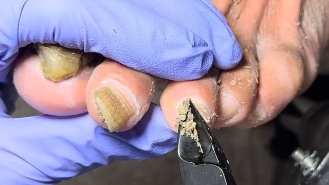 All the nails are infected by onychomycosis and are covered with black mud【Doctor Liu Pedicure】 смотреть онлайн