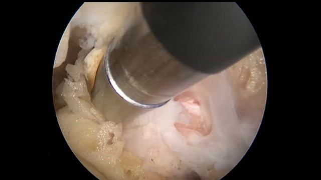Эндоскопическая декомпрессия плечевого сплетения в области грудной апертуры.