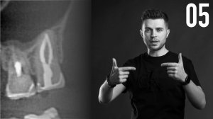 Уроки эндодонтии. Купирование болевого компонента при пульпитах