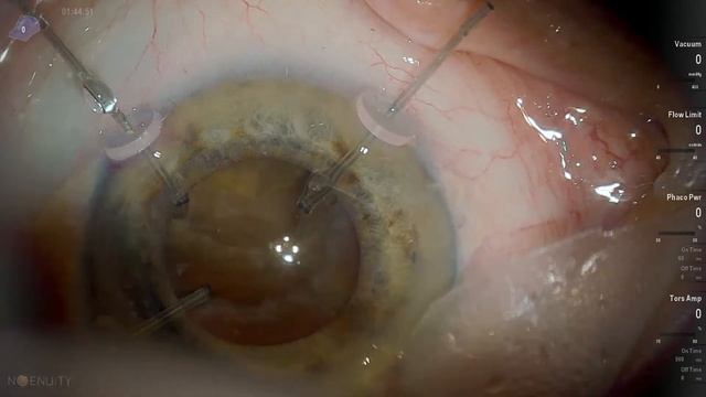 Dr Stanimir Troshev Livestream loose zonular support capsular hooks placement, sulcus implantation смотреть онлайн