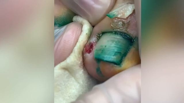 Вросший ноготь у ребёнка???? смотреть онлайн