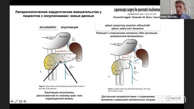 Современная диагностика и методы лечения пациентов с панкреатогенной гипогликемией смотреть онлайн