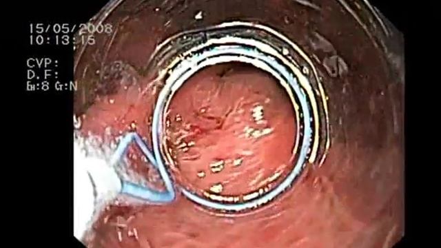 Лигирование Olympus ( Устройство для наложения лигатур на варикозно расширенные вены пищевода) смотреть онлайн