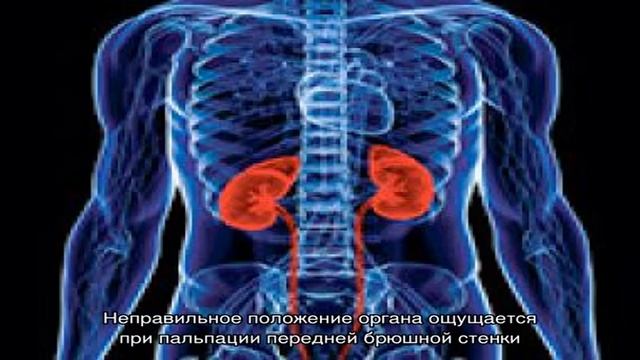 Что такое дистопия почки