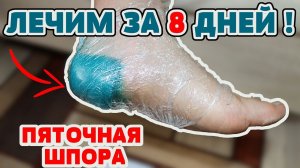 Как я вылечила ПЯТОЧНУЮ ШПОРУ за 8 дней!  Просто и Легко в домашних условиях народными средствами !