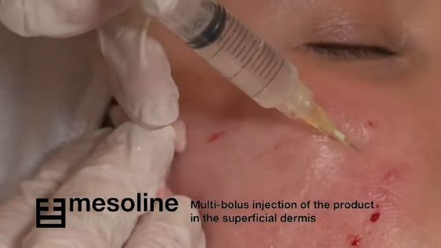Mesoline ANTIOX Injection Technique