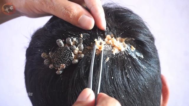 Removing Lice And Ticks Headache Poor Man #1024 смотреть онлайн