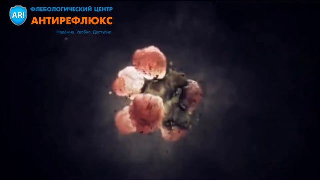 склеротерапия это смотреть онлайн