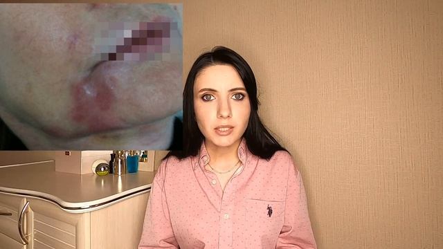 Страшные последствия применения филлеров! Осложнения в косметологии.