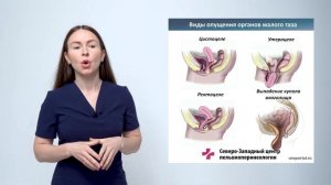 Стадии опущения органов малого таза