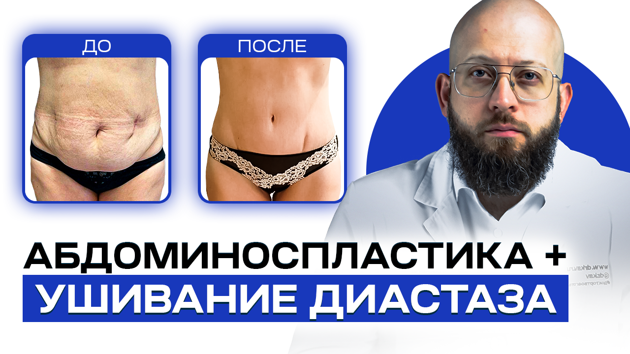 Абдоминопластика с ушиванием диастаза смотреть онлайн