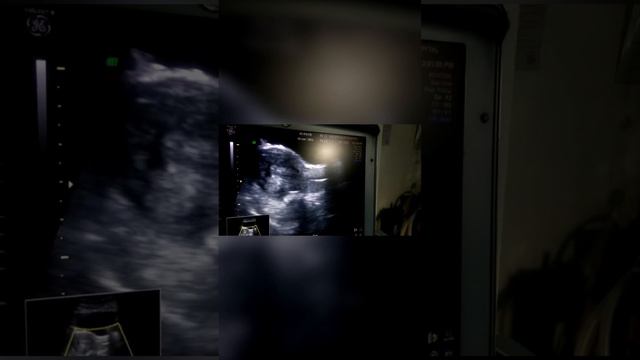 Let’s Do Embryo Transfer! | Dr. Priya Kalyani