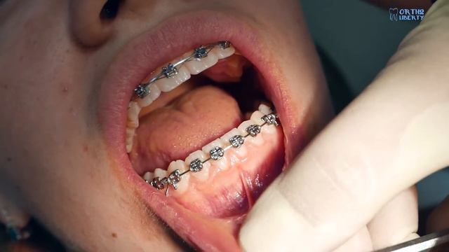 Пример работы с жидкотекучим материалом Ortho Flow