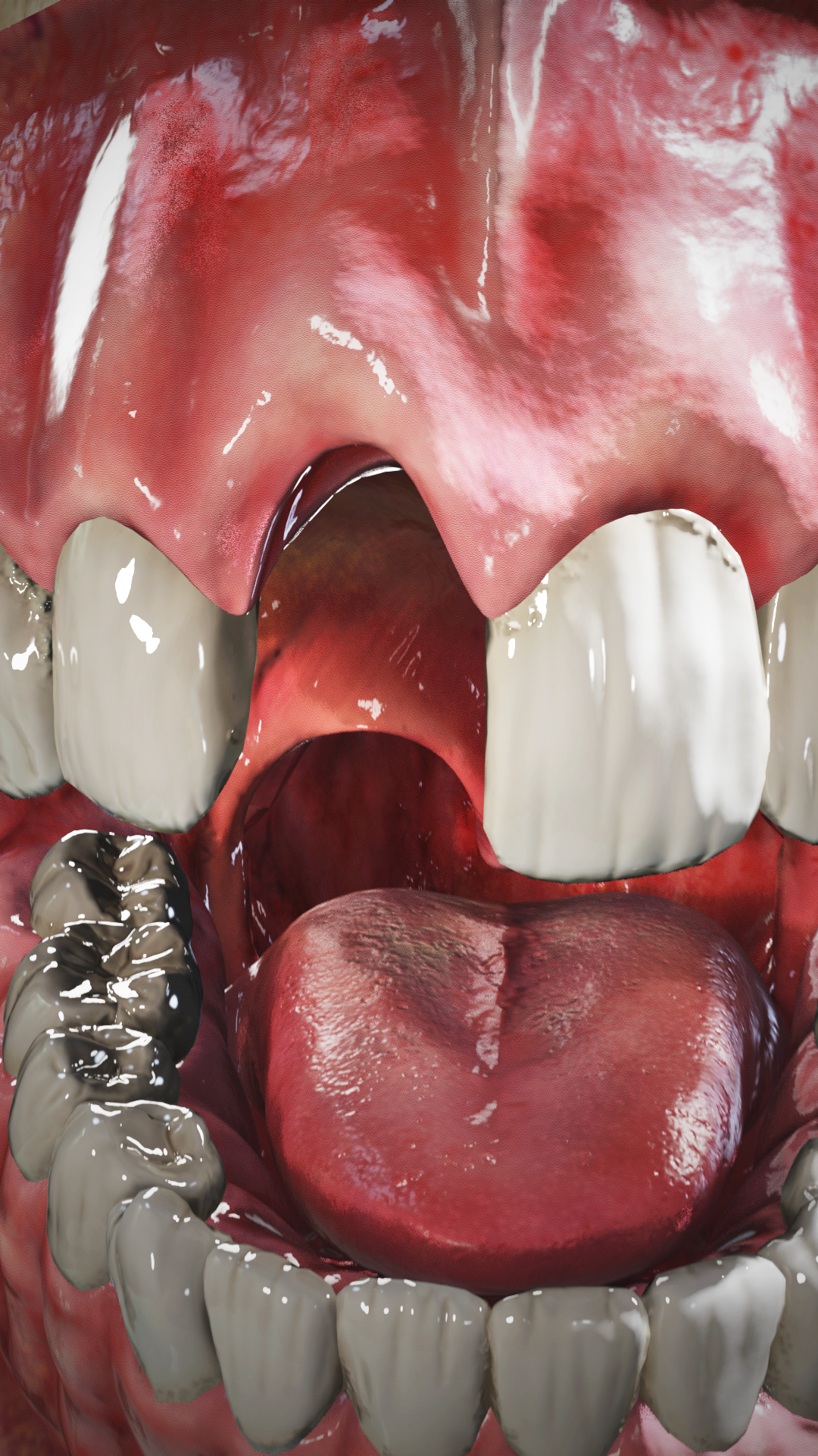 Костная пластика 🦷