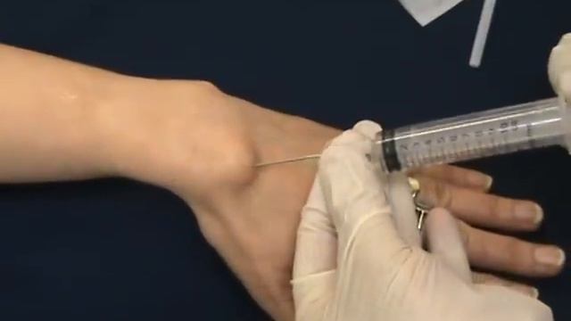 wrist ganglion aspiration смотреть онлайн
