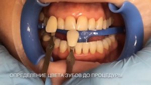 Мастер-класс по отбеливанию зубов системой Beyond Polus Advanced в стоматологии УмкаБелМед.