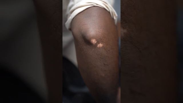 Vitiligo permanent skin color tattoo treatment смотреть онлайн
