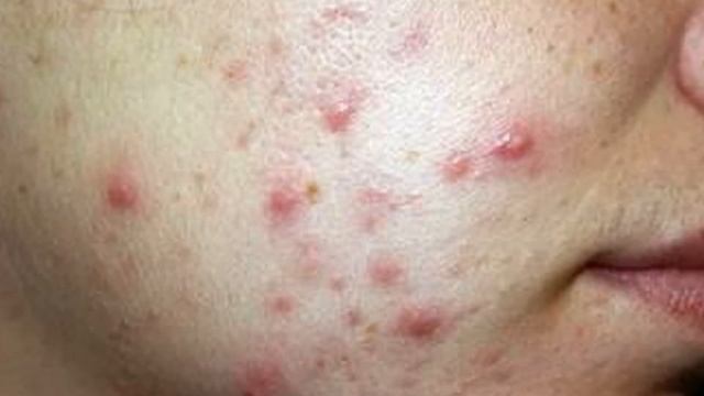 Прыщи на скулах женщин смотреть онлайн