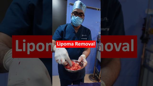 Lipoma Cure | 30+ Lipoma Removal from Patient hand #shortvideo смотреть онлайн
