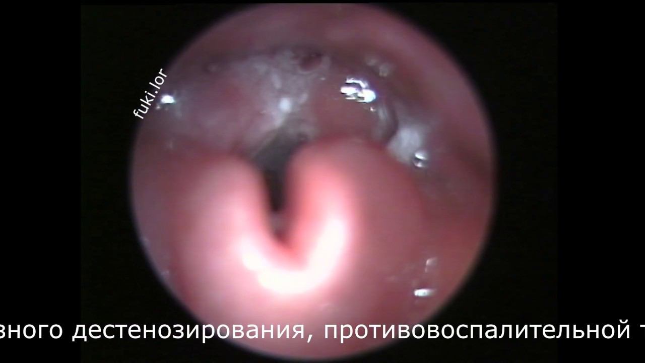 Флегмонозный ларингит