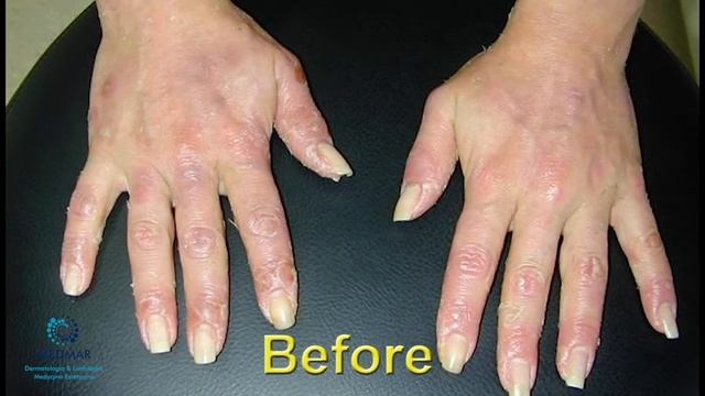 Leczenie światłem (fototerapia) смотреть онлайн