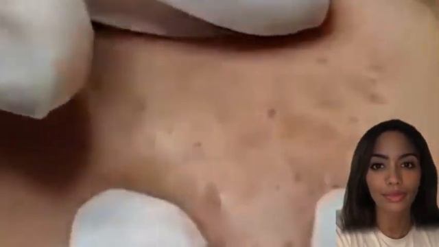 Blackheads Popping pimple Spa Relaxing beauty 2023 #2 смотреть онлайн