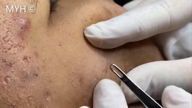 Tons Of Blackheads L Blackheads Extraction EP.8