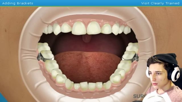 УСТАНОВКА БРЕКЕТОВ