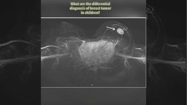 What are the differential diagnosis of breast tumor in children? смотреть онлайн