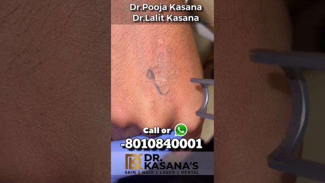 World’s best laser for Tattoo Removal Treatment at Dr Kasana’s Clinic смотреть онлайн