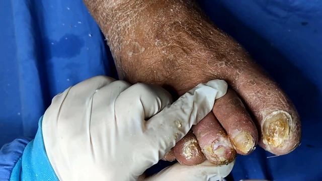 Massive Fungal Toenails : Trimming Fungal Toenails of a Diabetic Patient - #Part 2 Podiatry смотреть онлайн